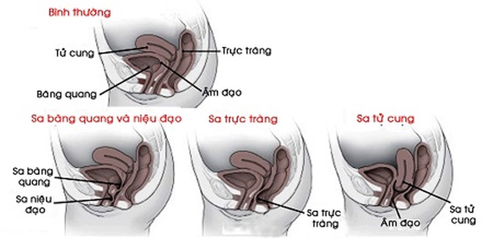 TẠI SAO PHẢI KHÁM SÀN CHẬU SAU SINH