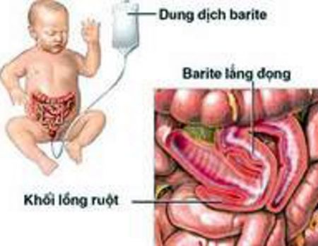 Cách phát hiện và ngăn ngừa lồng ruột ở trẻ